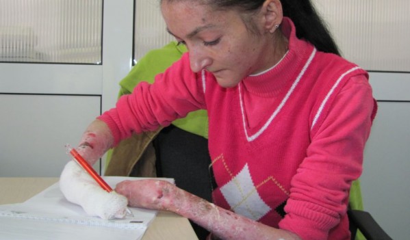 Apel umanitar: Oana suferă de o maladie rară care îi macină pielea și oasele Apel umanitar: Oana suferă de o maladie rară care îi macină pielea și oasele